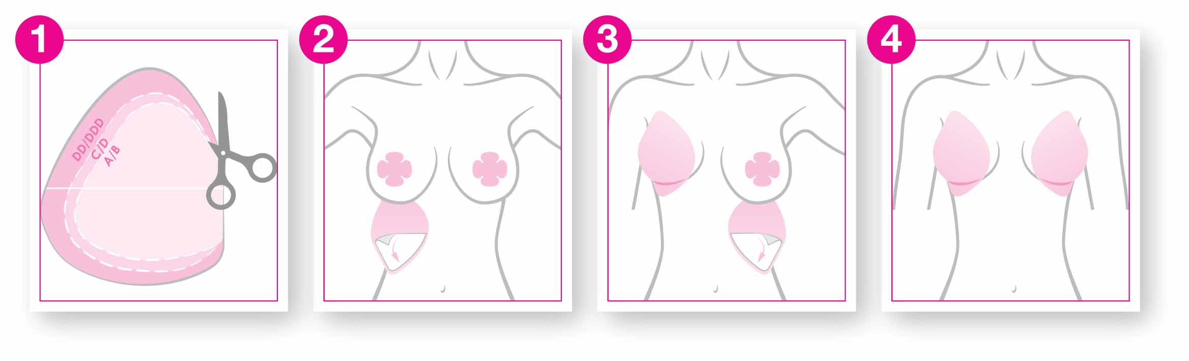 Illustration of a breast augmentation process with stages labeled 1 to 4.